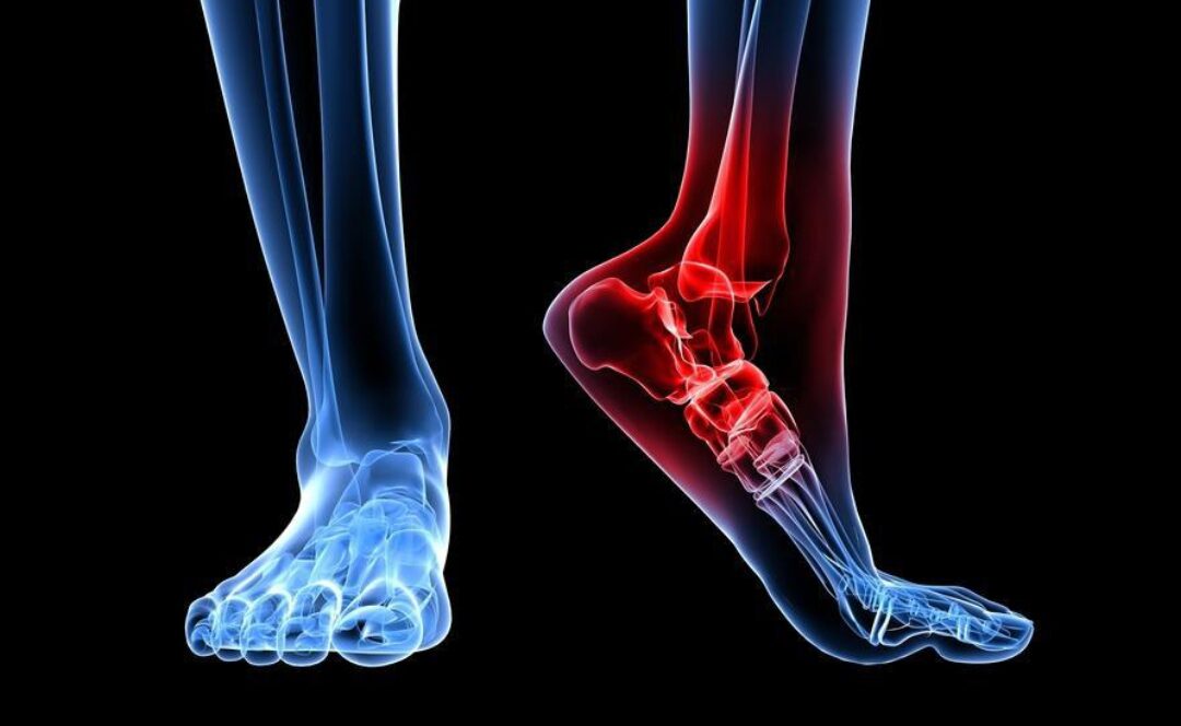 Aşil Tendonu Rüptürü